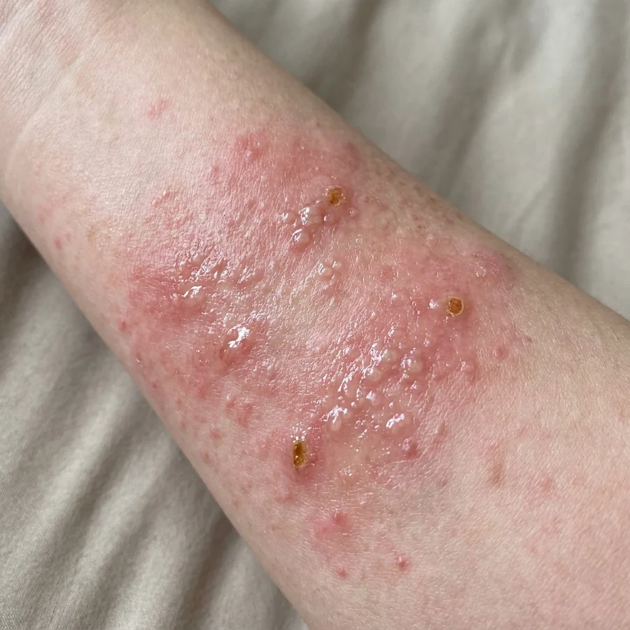 急性濕疹：紅、腫、出水、痕到瞓唔著