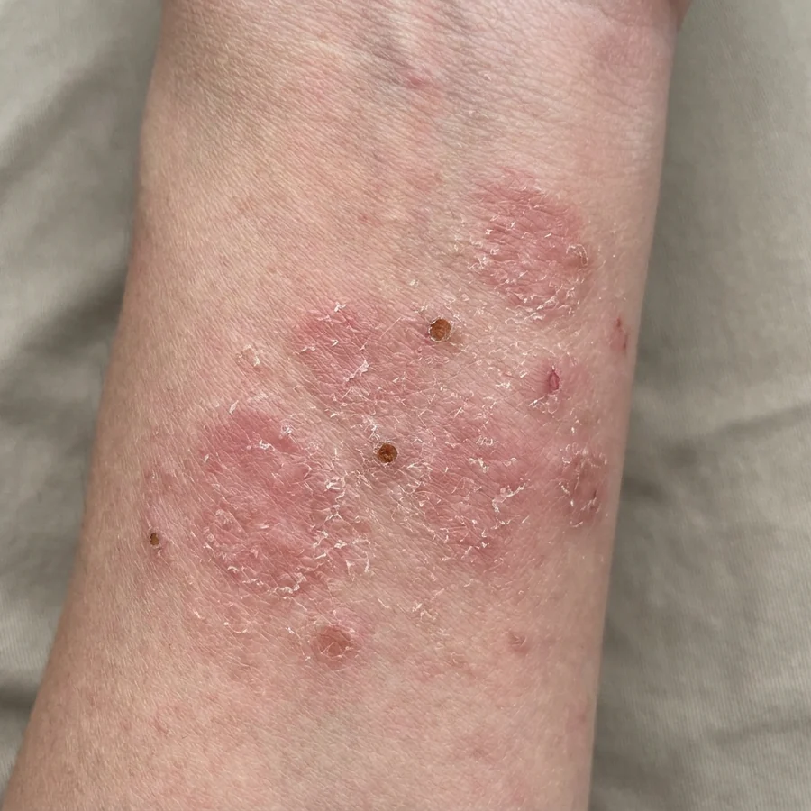 亞急性濕疹：開始脫皮結痂，但仲係紅